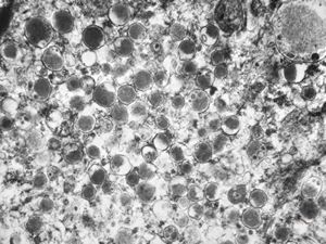 F,68y. | caecum - carcinoid F,68y. | caecum - carcinoid